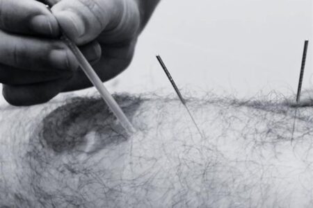 Dry Needling