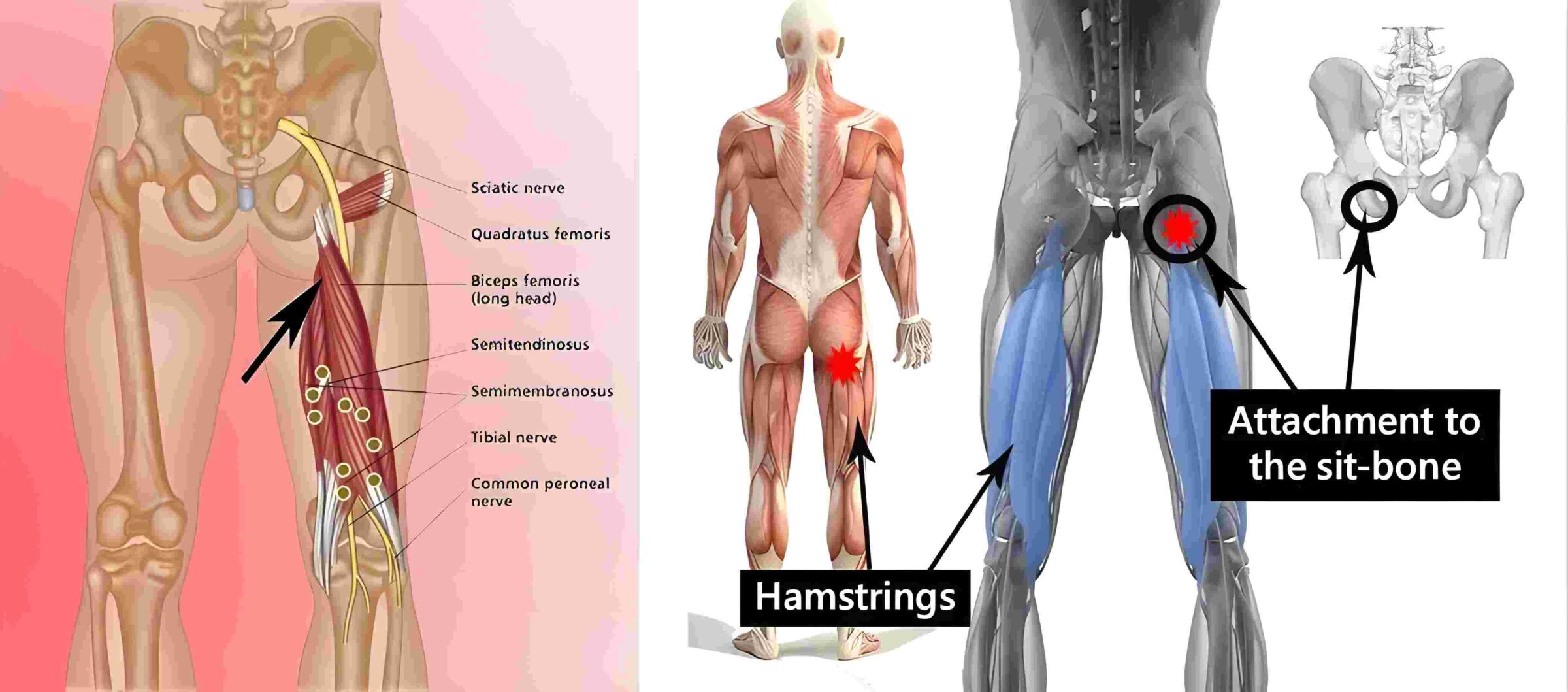 What is Proximal Hamstring Tendinopathy