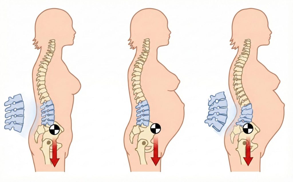 Illustration of pelvic tilt changes during pregnancy affecting the sacroiliac joint.